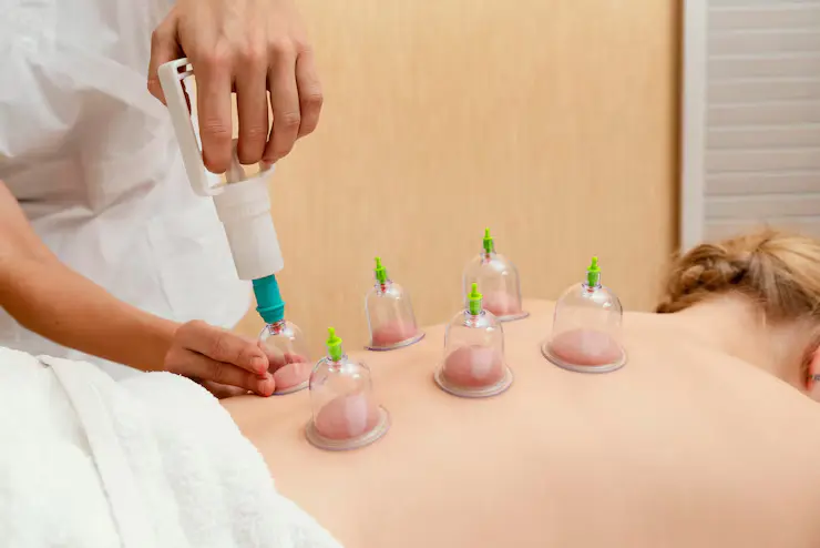 cupping-therapy-experience