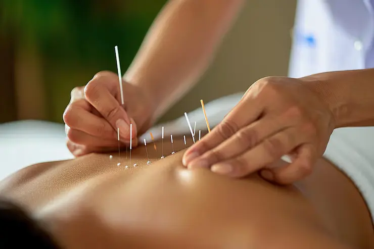 acupuncture therapy benefits