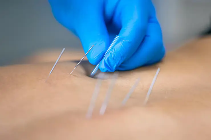 acupuncture massage therapy